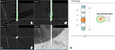 Subthalamic Deep Brain Stimulation Lead Asymmetry Impacts the Parkinsonian Gait Disorder